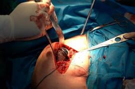 جراحی نادر تعویض مفصل شانه در بیمارستان شهید بهشتی بابل