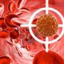 درمان قطعی سرطان مزمن خون با پیوند سلول‌های استخوانی